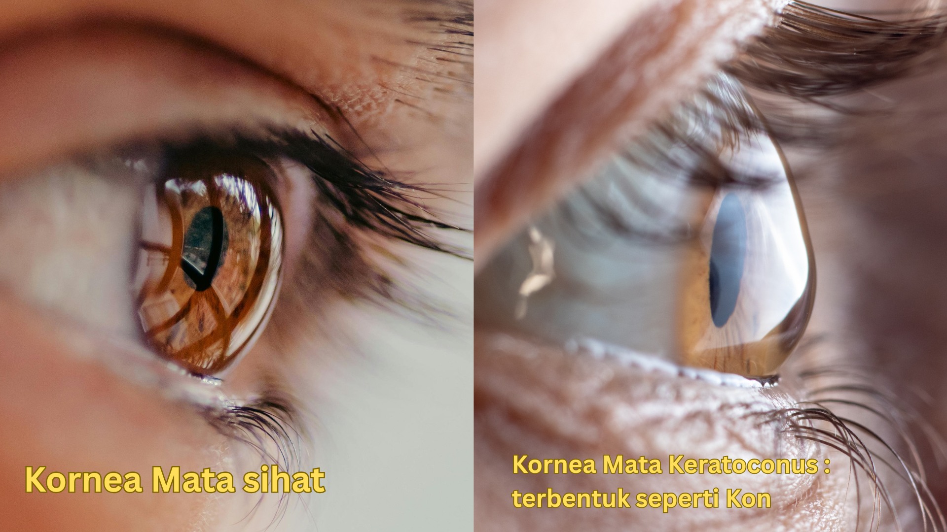 Ilustrasi keratoconus