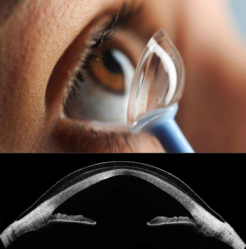 Scleral Lens